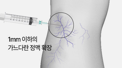 하지정맥류 수술 갑상선질환