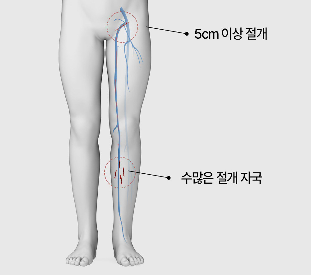 하지정맥류 수술 갑상선질환