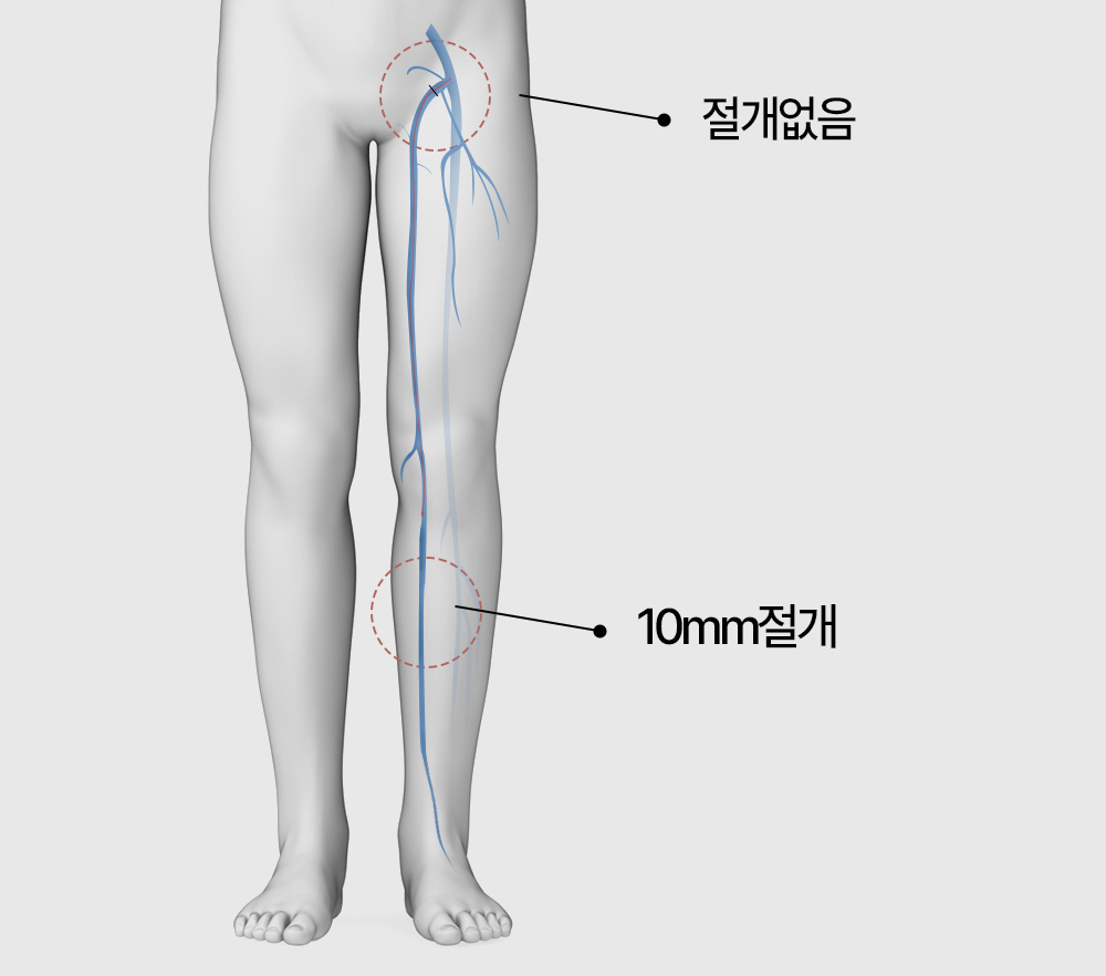 하지정맥류 수술 갑상선질환