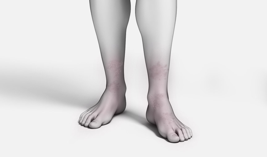 하지정맥류 수술 갑상선질환